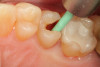 Fig 3. The lesion is excavated with a Smart BurII® (SS White) to remove infected dentin only.