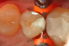 Fig 6. A bioactive cavity liner (TheraCalTM LC, Bisco Dental Products) is placed then cured on the affected dentin to the edge of the matrix because there is little to no enamel at the cavosurface margin of the preparation.
