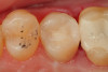 Fig 7. An occlusal view of the completed composite restoration of tooth No. 13.
