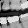 Fig 8. A vertical bitewing radiograph of tooth No. 13 after the restoration is completed. The tooth will be monitored clinically and radiographically for symptoms over the next 12 months to determine if root canal therapy will ultimately be necessary.