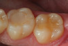 Fig 9. A preoperative occlusal view of teeth Nos. 18 and 19 with composite restorations that are exhibiting marginal breakdown.