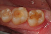 Fig 10. After removal of the existing restorations and associated recurrent decay, both cavities are very deep and there is a pinpoint pulpal exposure on tooth No. 19.
