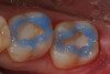 Fig 12. Selective etch of enamel is performed using Select Etch HV® (Bisco Dental Products).