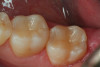 Fig 14. An occlusal view of the completed composite restorations on teeth Nos. 18 and 19.