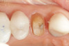 Fig 16. An occlusal view of the preparation on tooth No. 13 before cementation.