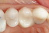 Fig 17. After application of self-etching resin cement (TheraCem®, Bisco Dental Products) to the internal surface of the restoration, the restoration is fully seated on the preparation expressing excess cement around the marginal area.