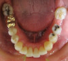 Fig 9. Clear aligner treatment was recommended to this patient, who presented with a missing lower molar combined with
posterior and anterior malocclusion.