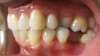 Fig 12. Clear aligner treatment was recommended to this patient, who presented with a missing lower molar combined with
posterior and anterior malocclusion.