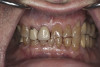 (10.) Preoperative anterior, closed view. Note the end-to-end occlusion of the anterior teeth and the wear on the incisors and centrals resulting in no anterior or canine guidance.