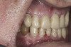 (23.) Provisionals, right lateral, closed view.