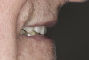 (30.) Postoperative profile smile view. Note the incisal edges pointing toward the inner vermillion border of the lower lip.