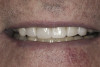 (31.) Postoperative smile view. Note the ideal esthetic length of the incisors and how the incisal edges follow the lower lip line.