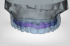 Laboratory CAD/CAM software showing full-arch prosthesis with substructure design (Fig 1), and final CAD/CAM prosthesis (Fig 2).