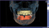 CAD/CAM scans of mandibular and maxillary arches merged with CBCT data.