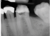 (5.) Preoperative radiograph of tooth No. 19 following a pulpectomy procedure that was complicated by an intraoperative furcal perforation.
