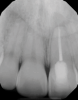 (9.) Preoperative radiograph of previously treated tooth No. 9, which received a diagnosis of acute apical abscess secondary to childhood trauma and recurrent endodontic pathology.