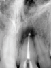(10.) Posttreatment radiograph and cone-beam computed tomography (CBCT) scan following nonsurgical root canal re-treatment that resulted in incomplete resolution of symptoms in response to percussion and palpation.