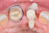 Fig 4. Occlusal view of the prepared tooth and a customized transfer abutment.