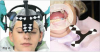 Fig 2. Micron optical jaw tracking camera detects jaw relationship using
mounted jaw tracking markers, head gear tracker for maxilla (left), and
tooth-attached jaw tracker for mandible (right).