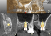 Fig 7. Evaluation of implant placement and sinus elevation with
navigational unit software by superimposing pre- and postoperative
CBCT plan and surgical outcome.