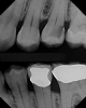 Fig. 2. A radiographic view of the extensive carious lesion on the distal of tooth No. 13.