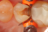Fig 6.	An occlusal view of the cavity preparation on tooth No. 13 after placement of the sectional matrix (Garrison 3D Sectional Matrix, Garrison Dental Solutions).