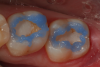 Fig 14. Selective etch of enamel is performed using Select Etch HV (Bisco Dental Products)