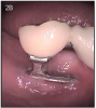 Figure 2B – Exposure of the implant was a common complication