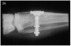 Figure 3A – Radiograph of the microscope bone chamber used by Dr. Brånemark in a rabbit fibula to study bone healing (Courtesy of Nobel Biocare)