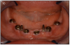 Figure 10 – Six implants placed in the lower arch with 2 mini-implants to help keep denture stable