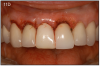 Figure 11D – Immediate placement of temporary crown over the abutment; laser crown lengthening was performed on the adjacent teeth to improve gingival symmetry