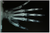 Figure 12 – Hand-wrist radiograph verifies complete growth