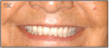 Figure 13C – Fully edentulous patient restored with maxillary and
mandibular implant supported implants