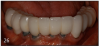 Figure 26 – Peri-implantitis – note the exposed implants, receding gingiva and plaque present on the exposed implant surfaces