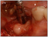 Figure 27B – Gingiva incised and a trephine drill used to remove fractured implant
