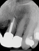 (4.) Radiograph of a root fracture that occurred at the end of a parallel metal post.