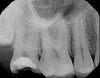 Fig 5. Case 2: Periapical imaging of the maxillary right (Fig 5) and mandibular right (Fig 6) quadrants.