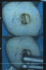Fig 2. In this tooth, the chamber is widened to remove obstructions for better canal visibility. (A) The chamber floor is widened with the round bur, and (B) the diamond shaper rests on the chamber floor.