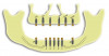 Fig 1. Strategic implant positions for the maxillary arch and mandibular arch for implant overdenture treatment.
