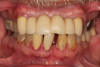 Fig 6. A 45-year-old man presented with a failing dentition requesting full-arch replacement.