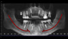 Fig 7. A cone-beam computed tomography scan (Green CT, Vatech America) showed that the patient had an abundance of bone quality and quantity for six implants on the maxillary arch and four implants on the mandibular arch. Implants were placed in positions that would allow a fixed restoration at a later date.