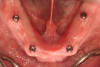 Fig 8. Definitive stud-style abutments (LOCATOR R-Tx, Zest Dental Solutions) were placed onto the mandibular implants.