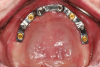 Fig 4. The completed milled bar with LOCATOR
abutments (Zest Dental Solutions) is evaluated intraorally to
ensure passive fit.