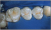 Figure 2 - Teeth to be sealed isolated with a dental dam