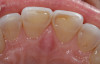 Fig 1. A palatal view of tooth Nos. 8 and 9 showing extreme wear. The incisal one-third of the clinical crowns have very little supportive dentin left, so it was decided to protect these teeth with ceramic restorations.