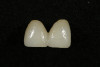Fig 5. The provisional restoration characterized with acrylic stain (Minute Stain: Taub Products).