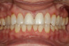 Fig 6. A facial view of the provisional restorations before their removal at the delivery appointment.