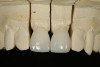 Fig 7. A facial view of the definitive restorations on the master model.