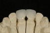 Fig 8. A palatal view of the definitive restorations on the master model.
