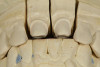 Fig 9. An inferior facial view of the mounted master models. The concavities in the preparations should be noted to compensate for the added space needed for the ceramic to have the proper thickness for strength.